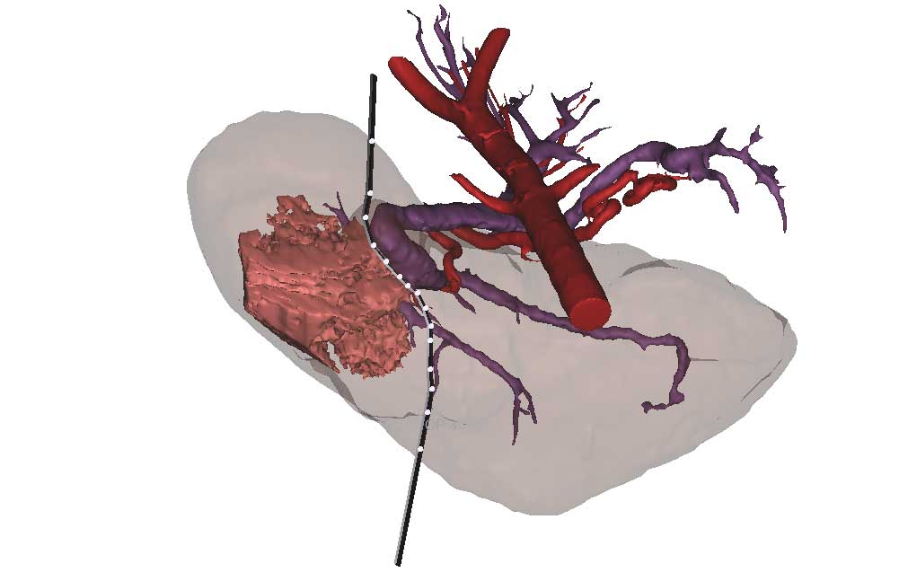 Positioning the cutting plane for tumor (in pink) resection